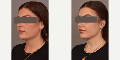 Woman treated with Mini Neck Lift - Woman treated with Mini Neck Lift, Buccal Fat Removal, and Cheek Liposuction.