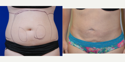 25-34 year old woman treated with Tickle Lipo - Tickle Lipo
