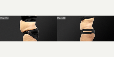 55-64 year old woman treated with Tummy Tuck, Diastasis Recti Repair, Liposuction, Scar Removal Surgery - This patient is in her mid 50's and is pictured here 3 months post-op from a standard abdominoplasty, scar revision, diastasis recti repair, and liposuction to bilateral flanks.