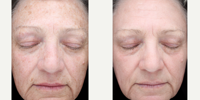 60 year old woman treated with Halo Laser - This 60 year old woman was bothered by the pigmentation on her face caused by years of sun damage. She has diffuse pigmentation, enlarged pores, and fine wrinkles.
She underwent a series of two combination treatments using BBL (broad band light) and Halo Pro hybrid fractional laser treatments to diminish the pigment spots, shrink her pores and improve her fine lines and wrinkles. 
Individual Results May Vary