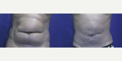 25-34 year old man treated with Tumescent Liposuction - Male patient with liposuction to abdomen and flanks.