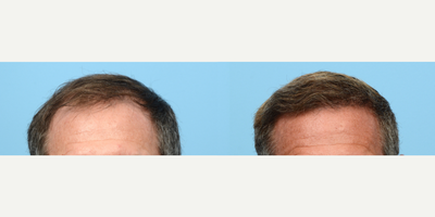 45-54 year old man treated with FUE Hair Transplant, Hair Transplant, NeoGraft, PRP for Hair Loss, Hair Loss Treatment - To restore his receding hairline, this 51-year-old patient came to Dr. Wise for an FUE hair transplant. During the procedure, the patient had 3,350 grafts implanted and a treatment of PRP to strengthen the follicles. 6 months post-op he is very happy with the results!