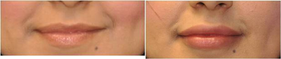 Permanent lip augmentation with Permalip implant in a young women - 
	young women that wanted permanent lip augmentation. She had tried HA fillers in her lips multiple times and was tired of undergoing lip injections to maintain the look she desired. A 4mm Permalip implant was placed in the upper and lower lip in the office.
