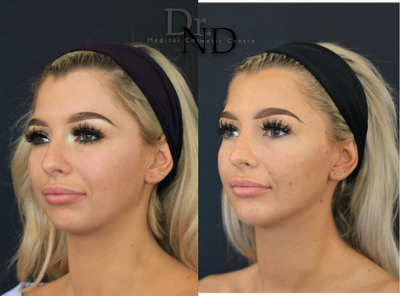 25-34 year old woman treated with Ellanse - Jaw and chin augmentation with Ellanse fillers
