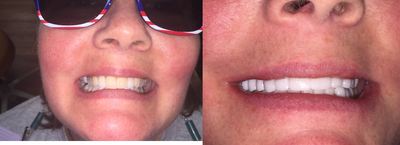 45-54 year old woman treated with 25 Porcelain Veneers and Crowns - Patient received a full mouth rehab that included 25 porcelain veneers and crowns. This post-opt picture was taken while the patient was still numb, so she could hardly smile. However, you can easily see the bright white smile and the better shape of the teeth. This was done in only two appointments with Dr. Sarah Thompson