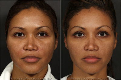 Sculptra & eMatrix - 
	Patient had 2.5 vials Sculptra to enhance facial contours and multi sessions of eMatrix in cheek area for skin resurfacing and smoothing.
