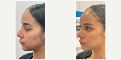 35-44 year old woman treated with Dermal Fillers, Botox, Nonsurgical Neck Lift - Mid Face and Under eye filler and botox to the lower face to lift the neck and lower face by Nurse Cindy.