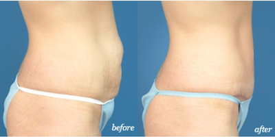 Woman treated with Tummy Tuck - Woman treated with Tummy Tuck