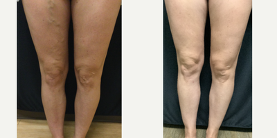 Sclerotherapy and RFA - Pre vs Post treatment of sclerotherapy & vein ablation