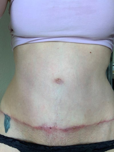 The Cosmetic Lane on X: An extreme case of Umbilical Hernia & severe Diastasis  Recti ✨ She's only 6 weeks post op  / X
