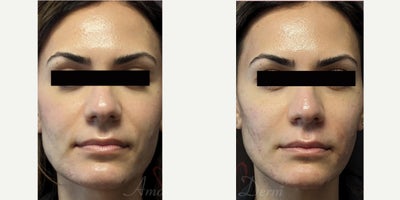35-44 year old woman treated with Liquid Facelift, Juvederm, Volbella, Voluma, Restylane - Liquid Facelift with filler injection in cheeks and nasolabial folds with Juvederm, Radiesse, Vollure, Restylane or Bellafill