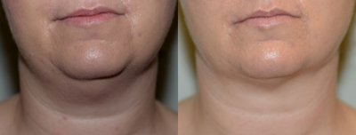 35-44 year old woman treated with CoolMini - This patient was treated with the CoolMini applicator with a submandibular approach.