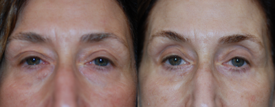 55-64 year old woman treated with Eyelid Surgery - 60 year old female undergoing upper and lower eyelift procedures