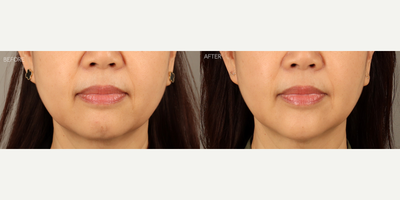 Chin and Nasolabial Fold FIller - 56-year-old female with a history of displeasure with her lower facial aesthetics, particularly lower facial folds and lack of jawline related to chin regression. She received filler to her nasolabial folds and her chin to soften folds and create a more youthful and proportional jawline.