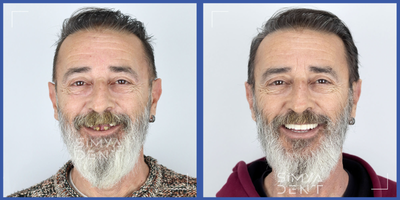 45-54 year old man treated with Full Mouth Reconstruction, Smile Makeover, Porcelain Veneers, Dental Implants - Patient lost dental health of all his teeth due to various diseases. Full mouth All-on-6 implant treatment was applied followed by porcelain fixed overdenture application.