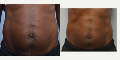 35-44 year old woman post-pregnancy treated with Body Fx - I used InMode Body Fx's suction device in order to melt and remove unwanted fat from this patient's abdominal area post-pregnancy. As you can see she was able to see some significant skin tightening immediately after the procedure.