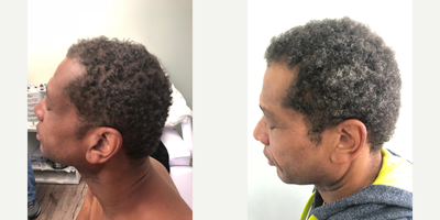 45-54 year old man treated with ALMI - ALMI for hair loss using stem cells and PRP.