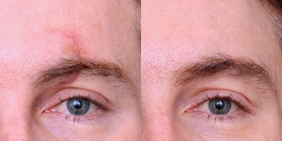 35-44 year old man treated with Scar Revision (Dermabrasion, CO2 Laser, Vascular Laser) - Scar revision with dermabrasion (surface irregularities), DeepFX (texture), and VBeam (redness). Comprehensive treatment for improved scar appearance.