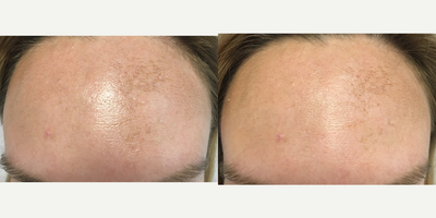 36 year old Latina woman treated with Dermaplanning - This procedure helps exfoliate the skin, and it is particularly helpful for superficial melasma. I typically perform this procedure prior to microneedling, and it allows the microneedling to be slightly more effective. All skin care products will work better, as the dead layers of skin are exfoliated with the use of a sharp blunt blade.