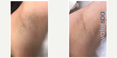 18-24 year old woman treated with Laser Hair Removal - Laser hair removal of the underarms.