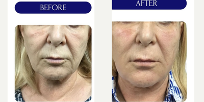 55-64 year old woman treated with Thread Lift, MINT threadlift - mint threadlift