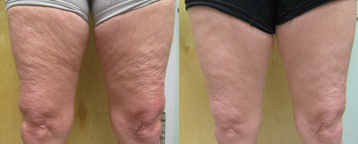 55-64 year old woman treated with BodyFX - Upper thigh treatment for cellulite