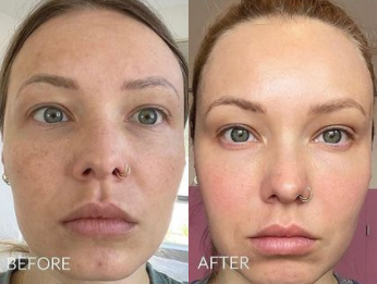 Woman treated with Morpheus8 - Woman treated with Fraxel Laser and Morpheus8