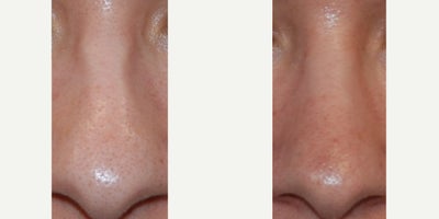 Non-Surgical Rhinoplasty Before & After: Softened the Appearance Nasal Bones - Our patient is an excellent example of the precision, permanence, and safety of microdroplet Silikon-1000 nasal injections for non-surgical nose enhancement. While her nose was proportionate to her face, she was bothered by congenital indentations along her nasal sidewalls and the prominence of her nasal bones. These after photos were taken following two treatments with microdroplet Silikon-1000, which permanently filled the indentations and softened the appearance of her nasal bones without the inconvenience, expense, or downtime of rhinoplasty. Additionally, Silikon-1000 is never associated with necrosis, embolism, infection, biofilm, blindness, or stroke. We are all thrilled with her refined nasal appearance.