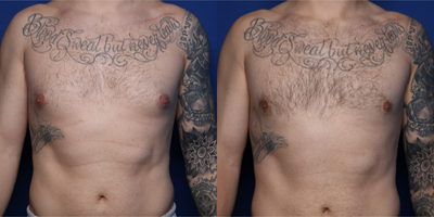 25-34 year old man treated with Gynecomastia Surgery - 28 y/o male shown 3 months after gynecomastectomy or excision of gynecomastia tissue that developed after steroid use.