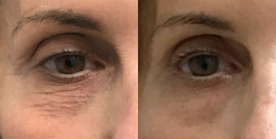 55-64 year old woman treated with Exilis - 4 monthly sessions for Exilis treats Crepiness around eyes.