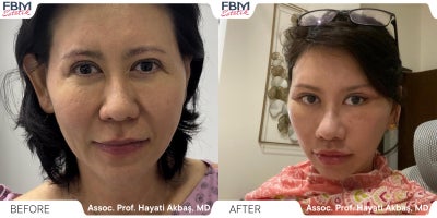45-54 year old woman treated with Deep Plane Facelift, Lip Lift, Canthoplasty - 55-64 year old woman treated with Deep Plane Facelift, Forehead Reduction, Eyelid Surgery, Lip Lift