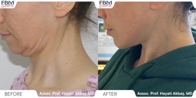 35-44 year old woman treated with Mini Neck Lift - 35-44 year old woman treated with Mini Neck Lift