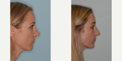 35-44 year old woman treated with Revision Rhinoplasty - Patient who had undergone a previous rhinoplasty and was seeking revision. Revision rhinoplasty techniques employed to help de-project her nose, correct the deformities of the bridge, and soften the pointy appearance to the tip.