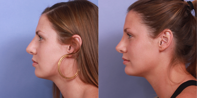 18-24 year old woman treated with Rhinoplasty - Rhinoplasty with Chin Augmentation