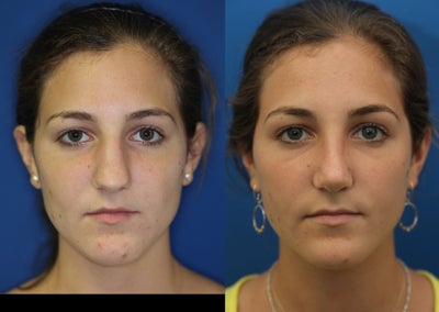 Rhinoplasty - 	This patient underwent open SeptoRhinoplasty.