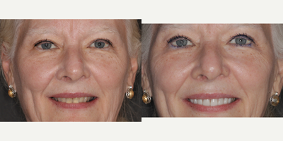 55-64 year old woman treated with Da Vinci Veneers, Porcelain Veneers - Female patient with a desire to change her smile, she was tired of discolored teeth and wanted to have a bright, better looking smile. We went ahead and completed our protocol utilizing our digital smile design software, she was happy with her proposal and our ceramist completed amazing results that transformed her smile just how she wanted. She is extremely happy with her results, we met and exceeded her expectations.