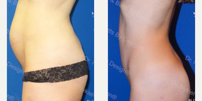 Woman treated with Tummy Tuck - Woman treated with Tummy Tuck