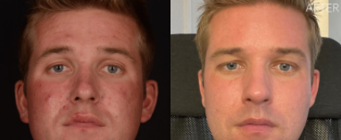 Man treated with Fractora RF - Man treated with Fractora RF