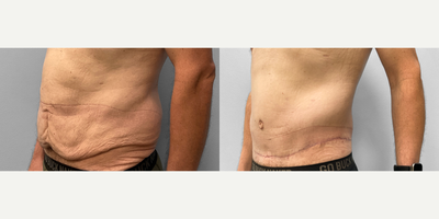 45-54 year old man treated with Body Lift - This man in his mid-thirties who lost over 140lbs was concerned about his loose skin and met with Dr. Tucker to discuss his options. He chose to proceed with a circumferential body lift and has been pleased with his results He looks great and is pictured 2 months after surgery.