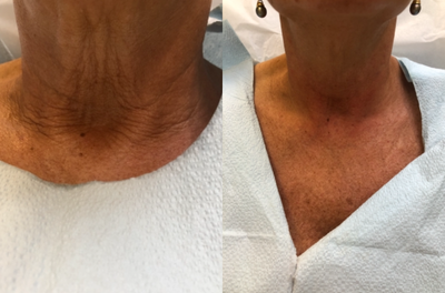 55-64 year old woman treated with Nonsurgical Neck Lift - Nonsurgical neck rejuvenation with PDO threads