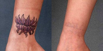 Have Keloid Scarring After Laser Tattoo Removal, What ...