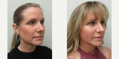 35-44 year old woman treated with Facelift, Brow Lift, Facial Fat Transfer - This patient underwent a Facelift, Endoscopic Browlift with an Anterior hairline incision and fat transfer to multiple areas of the face.