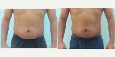 25-34 year old man treated with Exilis - 33 years old male presented with saggy tummy post weight loss desired to get it corrected in a non surgical way. 6 sessions of non surgical liposuction [exilis] done for tummy region. Post procedure pictures taken 2 months after completing exilis.