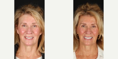 Woman treated with Smile Makeover - Full mouth rehabilitation complete to address old crowns, root canal teeth, and veneers that had all been done at different times over the last 15-25 years. We replaced many old root canal teeth with dental implants.