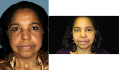 Secondary Facelift - This 58 yo lady was 12 years since her last facelift. She wanted a small touch up. We did a short scar SMAS facelift with fat grafting
