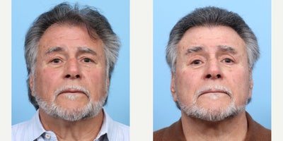 75 and up year old man treated with FUE Hair Transplant, Hair Transplant, Hair Loss Treatment, PRP Injections, PRP for Hair Loss - To restore this patient's hairline and add density, Dr. Wise performed an FUE hair transplant along with one treatment of PRP.