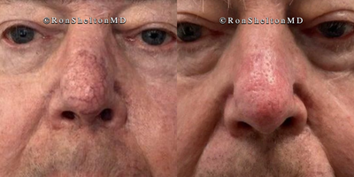 65-74 year old woman treated with Vbeam - After 4 pulsed dye V beam laser  treatments of unwanted broken blood vessels from rosacea on the nose