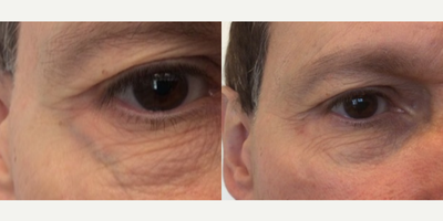 55-64 year old man treated with Laser Surgery - Excel V can treat the bulging veins of the periorbital area. He had 2 treatments, and the photo is 3 months after the second.