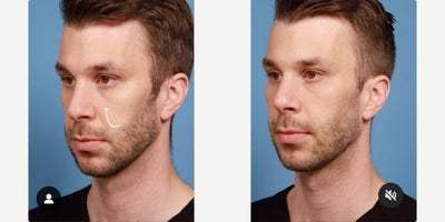 Man treated with PRF Treatment - Man treated with PRF Treatment