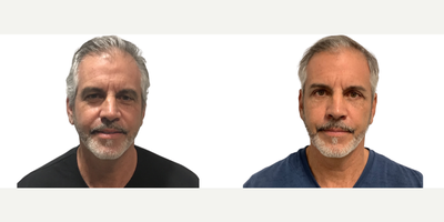 61 year old man treated with Eyelid Surgery, Double Eyelid Surgery, Canthoplasty - Periorbital RejuvenationOur lovely patient is 1 month post-op from a Brow Lift, Upper Blepharoplasty, and Lower Blepharoplasty with muscle & fat repositioning, and canthopexy.This 61-year-old man wanted to look younger and less tired, but still very natural! He has great facial bone structure & has aged well around the lower face and neck. I focused on rejuvenating his upper face. In men, the eyebrows should be lower than women's eyebrows & not be overly arched, which can result in a surprised look.Our patient has some Upper Eyelid skin redundancy, partially from the brows. The Lower Eyelids were dissociated from the cheek.